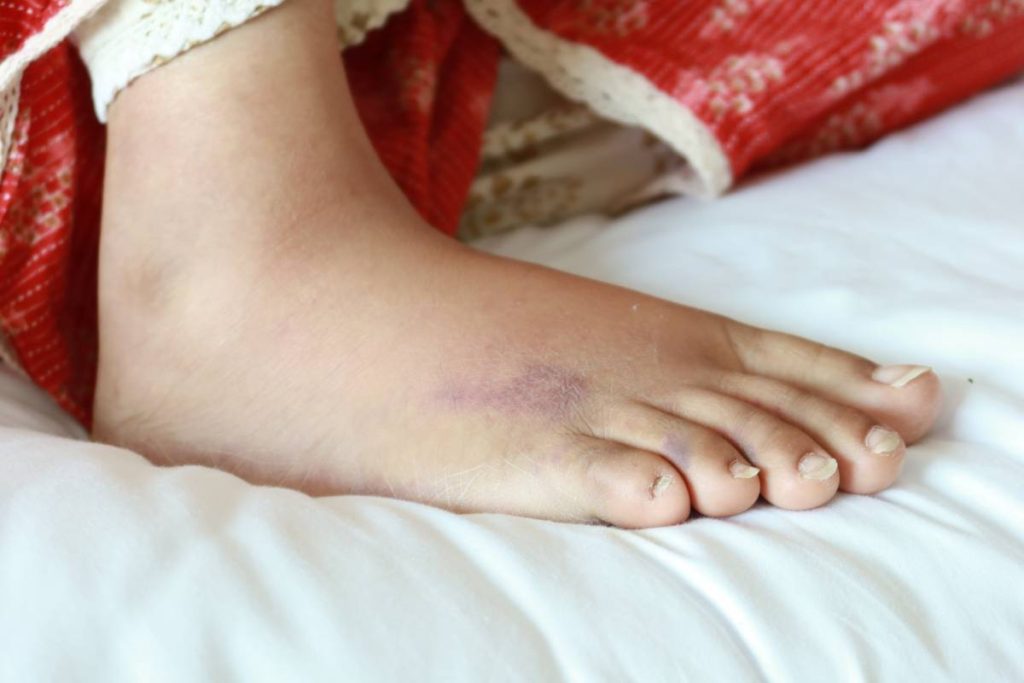 close up of women feet with swelling .